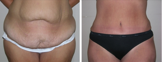 What Is a Body Lift?  Birmingham Plastic Surgery Specialists